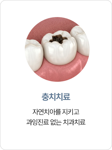 연세아크로치과 충치치료