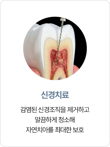 연세아크로치과 신경치료
